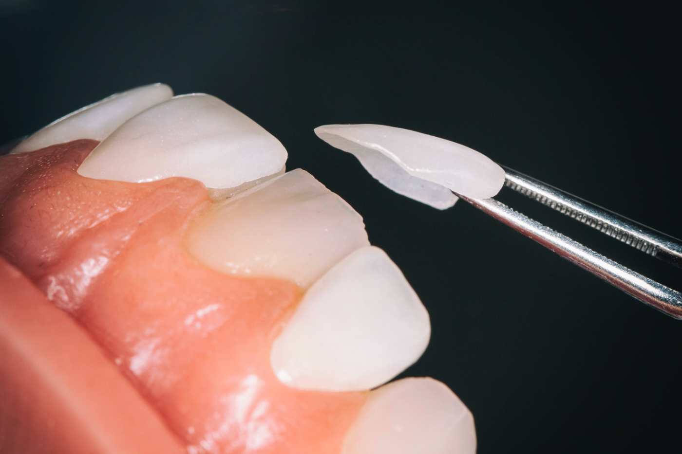 Faccette dentali: perché sceglierle?