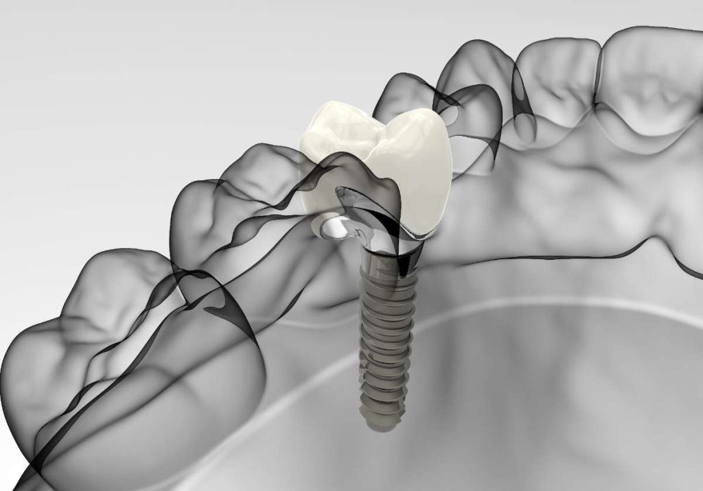 FAQ Impianti Dentali